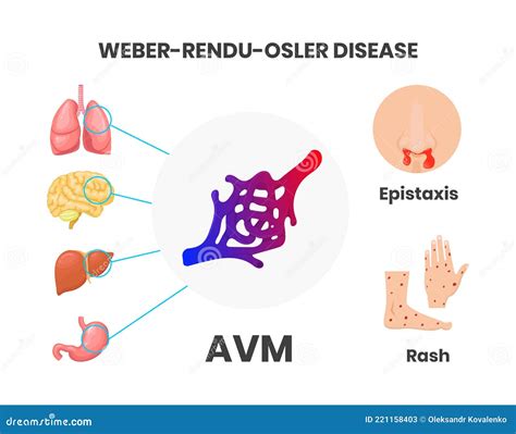 Osler Weber Rendu Syndrome