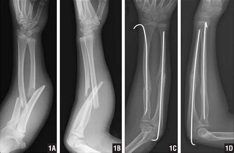 Ulnar Nerve Palsy Associated With Closed Midshaft Forearm Fractures