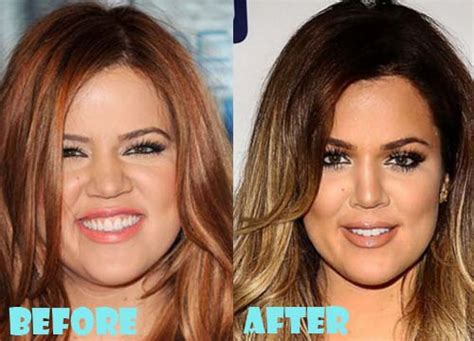 Khloe Kardashian Plastic Surgery Before and After Nose Job - Lovely Surgery | Celebrity Before ...