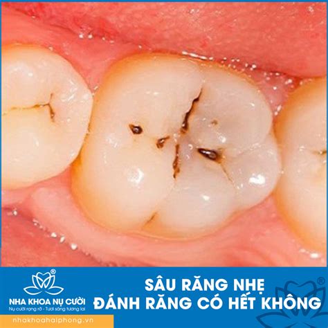 SÂU RĂNG NHẸ ĐÁNH RĂNG CÓ HẾT KHÔNG?