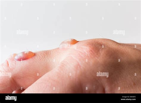 Plantar warts hi-res stock photography and images - Alamy