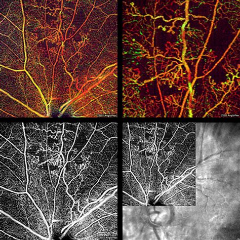 OCT Angiography - Retinal Imaging Technology | Medical Technology ...