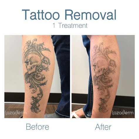 Laser Tattoo Removal in Chandler, AZ | Free Consultation — Lazaderm Laser & Aesthetics