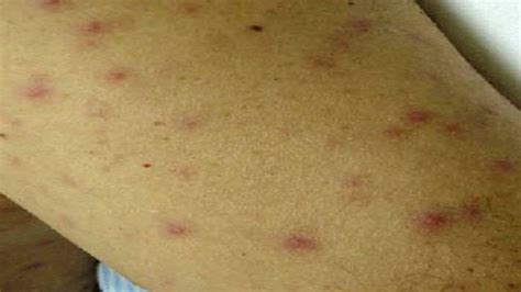 Typhus: Causes, Symptoms, and Diagnosis