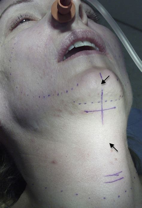 Short Scar Neck Lift - Clinics in Plastic Surgery