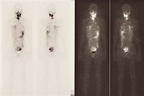 Radioactive Iodine Scan