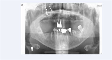 Figure 1 from Osteoma in the Maxillary Sinus : Report of Two Cases | Semantic Scholar