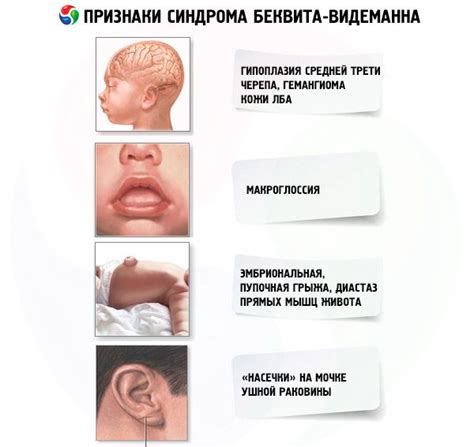 Beckwith-Wiedemann syndrome: symptoms, diagnosis, treatment