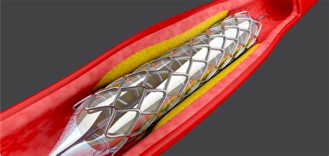 Cardiac Stent Price Capping - A Step Forward Or 2 Steps Backwards? - Heart Sense