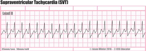 ECG Educator Blog : Six Second ECG Rhythm Strips