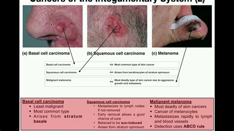 Anatomy | The Three Types of Skin Cancers - YouTube