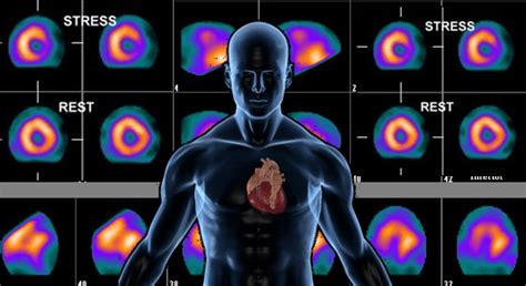 Nuclear Stress Test - Houston, TX & Cypress, TX: Heart Care Center of ...