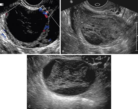 Hemorrhagic Corpus Luteum Ultrasound