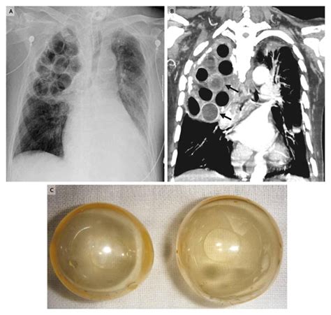 Flu Infections and MRSA Combine into Lethal Cocktail in Maryland