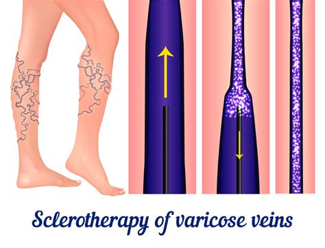 How long does it take to recover from varicose vein surgery? - Dekalb Vein Center