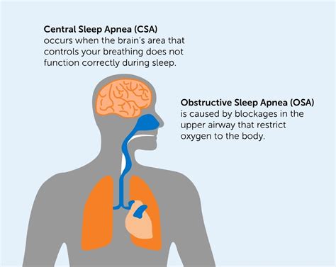 Central Sleep Apnea (CSA) | remedē® System