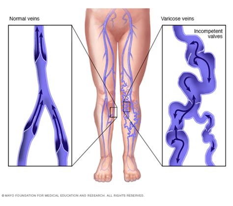 Varicose Veins | Varicose veins cause Mumbai | Varicose veins Doctors