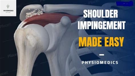 Shoulder Impingement Syndrome - Shoulder Acromion Pain - Shoulder Impingement Exercises - YouTube