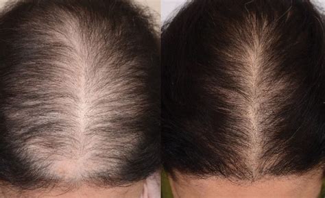 An All-Natural Treatment to Address Hair Loss | Mooresville Dermatology ...