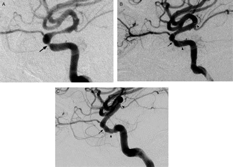 In a man with stenosis at the carotid siphon, digital subtraction ...