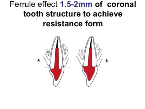 What is Ferrule in Dentistry? | News | Dentagama