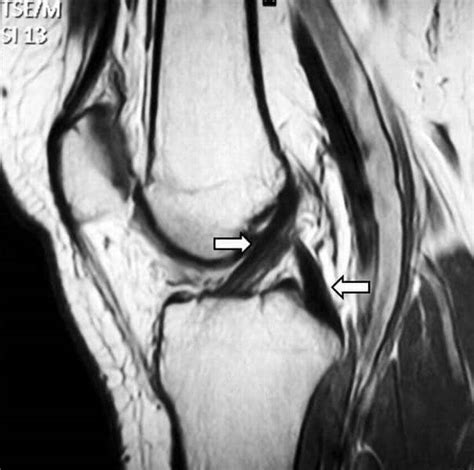 ACL Reconstruction Surgery - Sutured