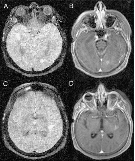 Distinctive MRI of patient 2. The initial scan after the onset of new... | Download Scientific ...