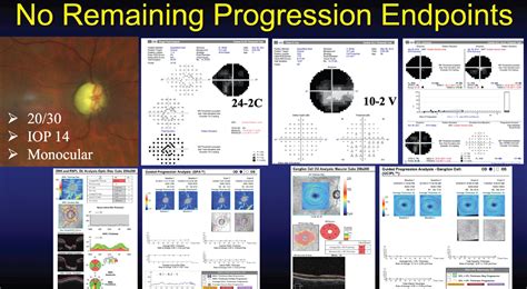 Detecting Progression in Severe Glaucoma