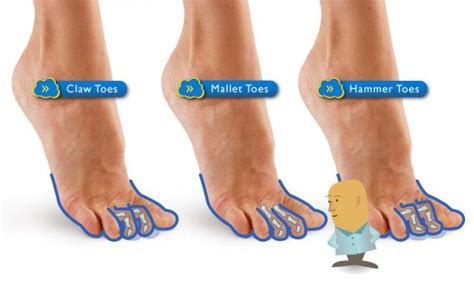 Hammer toes, clawed toes, curly toes - The Podiatry Centre Sydney | Hammer toe, Claw toe, Hammer ...