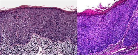 Erythroplasia Of Queyrat Histology