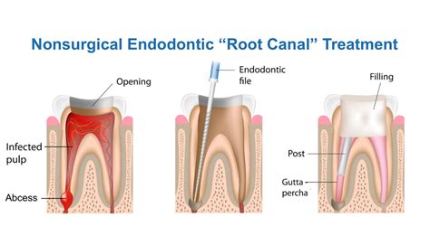 Endodontics Treatment - Imperial Dental Specialist Centre