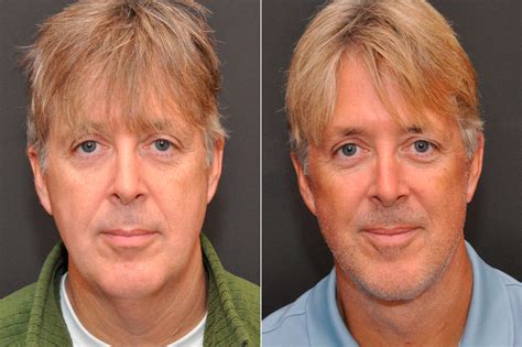 Male Plastic Surgery Photos | Cincinnati, OH | Patient 8092