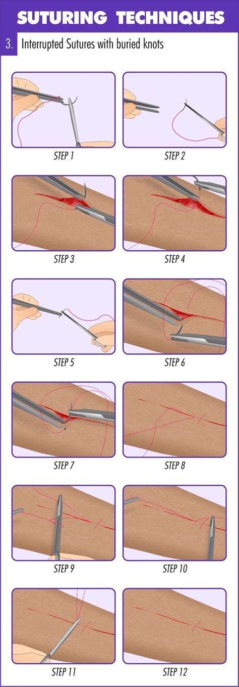 Complete Guide to Mastering Suturing Techniques | Suturing techniques ...