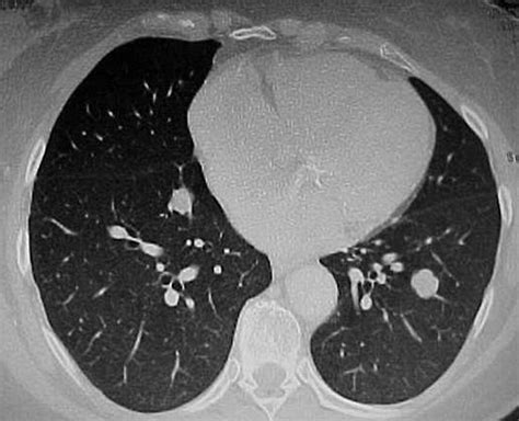 A 69-year-old female with multiple, bilateral pulmonary nodules | European Respiratory Society