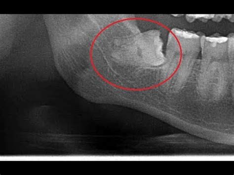 Horizontally impacted lower 3rd molar removal - YouTube