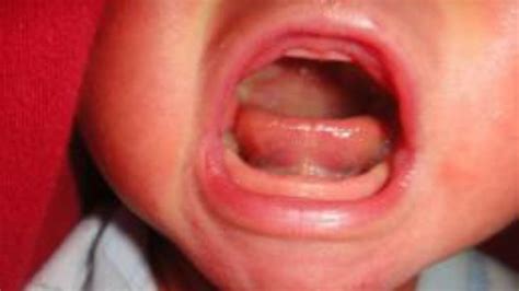 Petition · Posterior Tongue Ties to become a Key check upon a Baby's ...