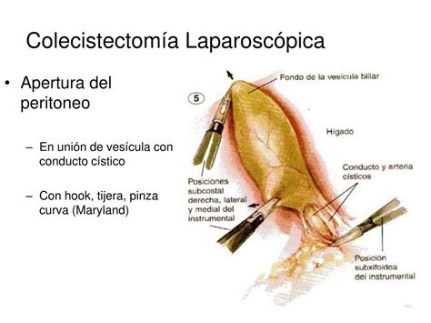 PPT - Colecistectomía Laparoscópica PowerPoint Presentation, free ...