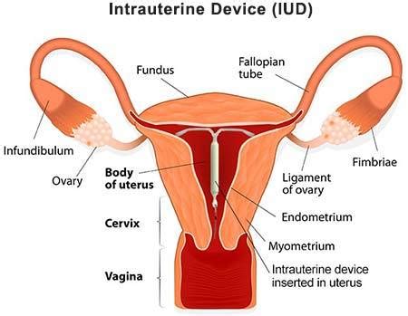 IUD Birth Control NYC· Insertion, Removal