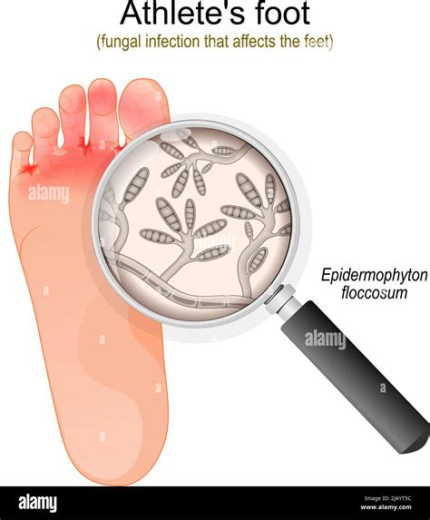 Athlete's foot. fungal infection that affects the feet. Close-up of ...