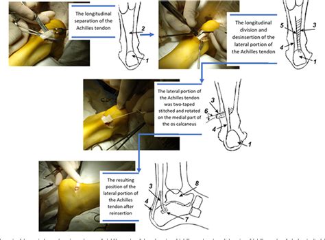 Figure 1 from Correction of Planovalgus Deformity Through Rotational Reinsertion of the Lateral ...