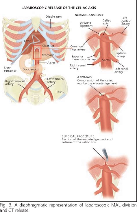 Figure 3 from The celiac axis compression syndrome (CACS): critical review in the laparoscopic ...