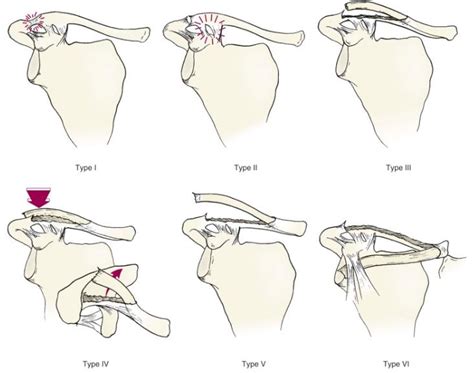 Clavicle Fracture Classification