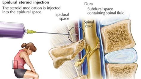 Epidural Steroid Injection Side Effects | Side Effects Of Epidural ...