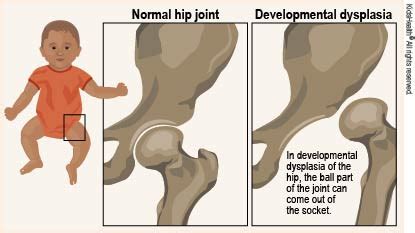 Developmental Dysplasia of the Hip (for Parents) - Humana - Louisiana