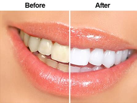 Teeth Scaling and Polishing - Rohit Dental Clinic