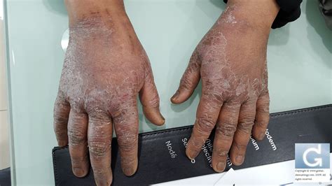 Global Dermatology » Classifying Hand Eczema is not Solving (Journal Club)