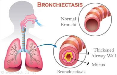 Bronchiectasis - Causes, Symptoms, Diagnosis, Prognosis, Treatment