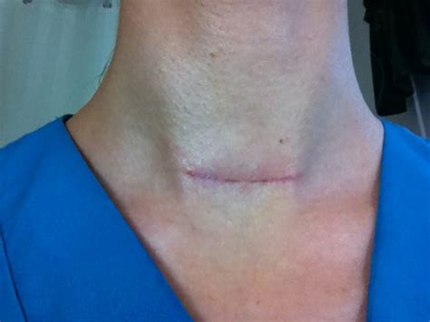 Thyroid Surgery Scar Treatment, Healing, Removal, Reduction, Therapy ...