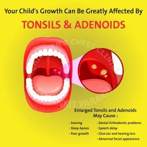 Enlarged Tonsils and Adenoids in Children: diagnosis & treatment - Dr. Ankit Parakh