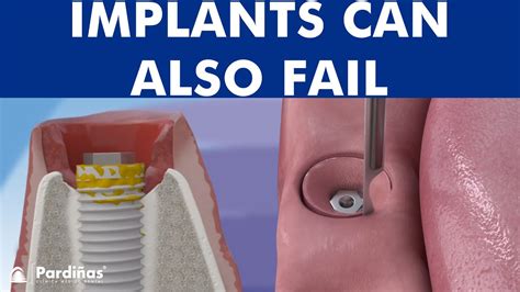 Peri-implantitis - Dental implant infection © - Dental Clinic